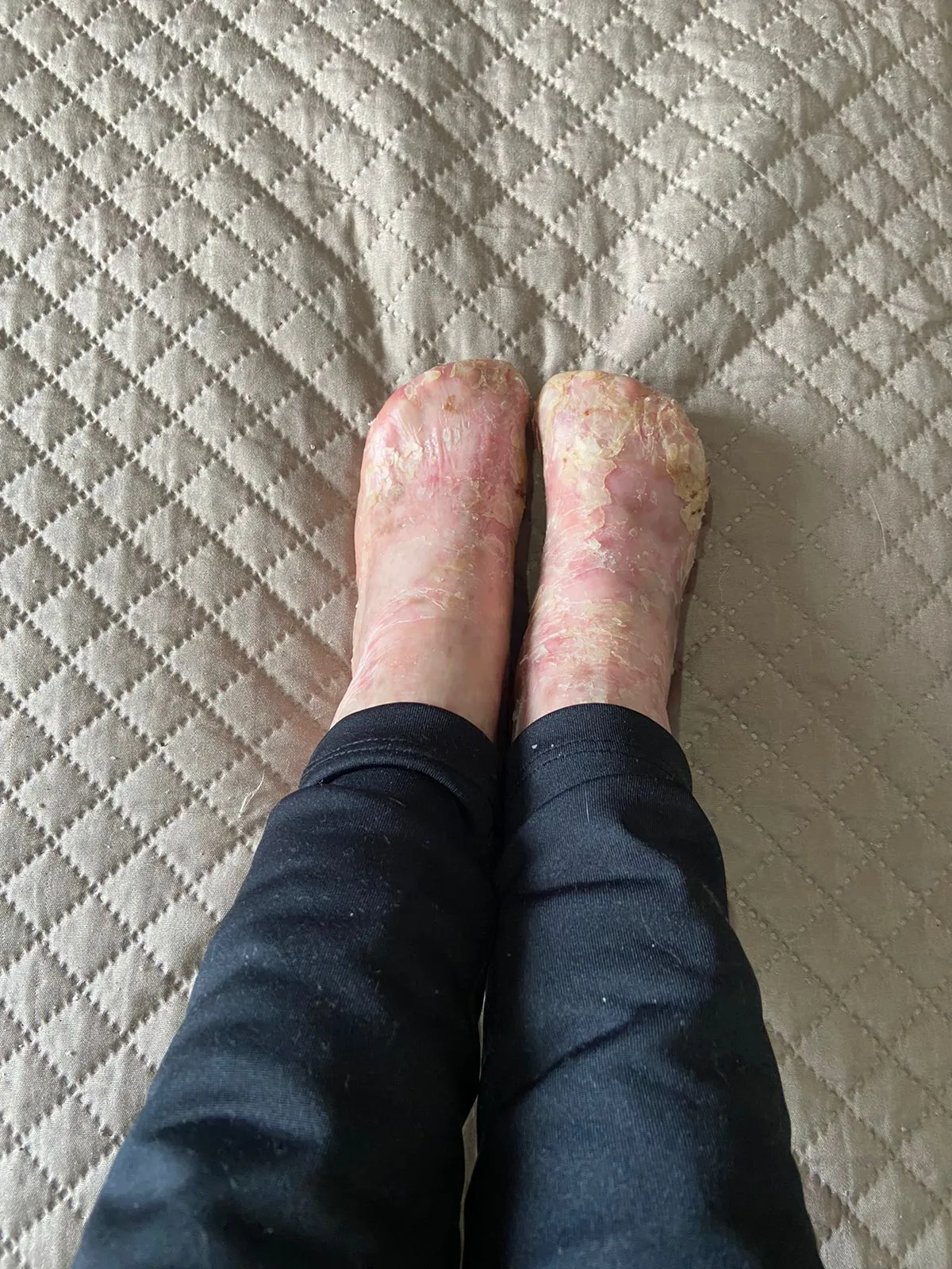 Amara's feet with raw, healing skin